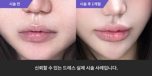 입술필러 + 티타늄