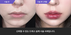 입술필러