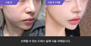 티타늄