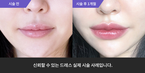 입술필러