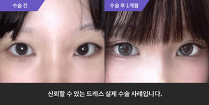 자연유착 + 앞트임 + 윗트임