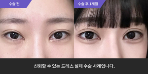 자연유착재수술 + 뒷트임 + 밑트임