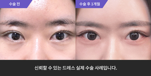 자연유착재수술 + 눈매교정재수술 + 뒷트임 + 밑트임