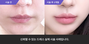 입술필러 + 울쎄라