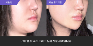 입술필러 + 슈링크
