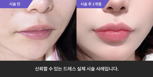 입술필러
