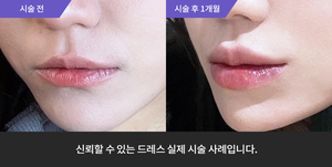 입술필러