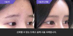 이마필러