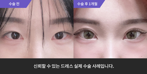 자연유착재수술 + 눈매교정