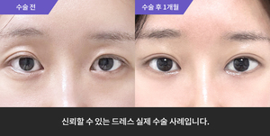 자연유착재수술 + 눈매교정 + 윗트임
