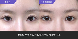 자연유착재수술 + 눈매교정 + 윗트임