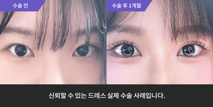자연유착재수술 + 눈매교정 + 윗트임 + 뒷트임재수술 + 밑트임
