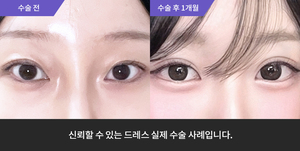 자연유착재수술 + 눈매교정 + 윗트임 + 뒷트임 + 밑트임