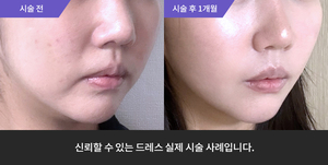 티타늄 + 사각턱보톡스