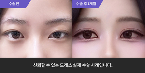 자연유착 + 뒷트임 + 밑트임