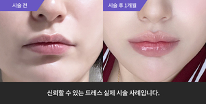입술필러 + 암살주사