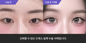 자연유착재수술 + 눈매교정