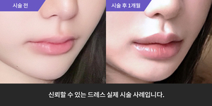 입술필러