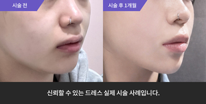 슈링크