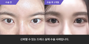 자연유착재수술 + 뒷트임 + 밑트임