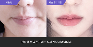 입술필러