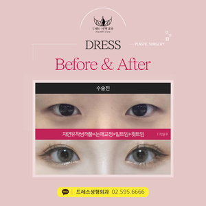 자연유착쌍꺼풀+눈매교정+밑트임+윗트임