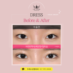 자연유착쌍꺼풀+눈매교정+앞트임