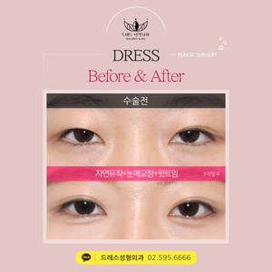 자연유착쌍꺼풀+눈매교정+윗트임