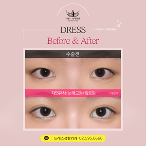 자연유착쌍꺼풀+눈매교정+앞트임