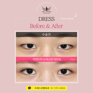 자연유착쌍꺼풀+눈매교정+윗트임