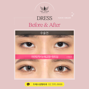 자연유착쌍꺼풀+눈매교정+윗트임