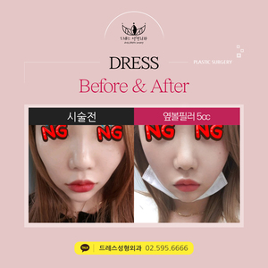 옆볼필러5cc