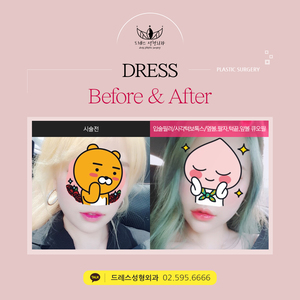 입술필러+사각턱보톡스+큐오필플러스