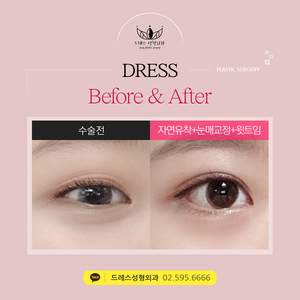 자연유착쌍꺼풀+눈매교정+윗트임
