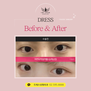 자연유착쌍꺼풀+눈매교정