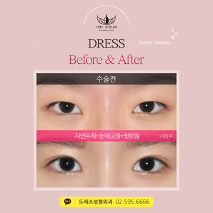 자연유착쌍꺼풀+눈매교정+윗트임