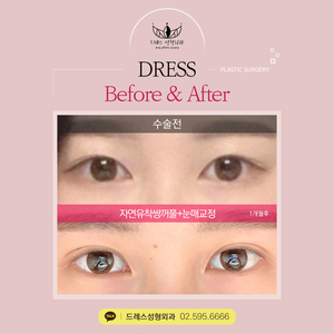 자연유착쌍꺼풀+눈매교정