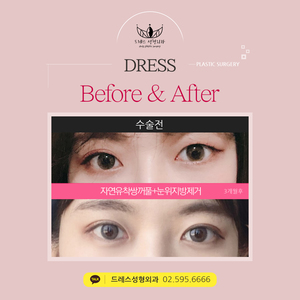 자연유착쌍꺼풀+눈위지방제거