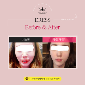 턱필러+팔자필러