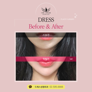 턱필러