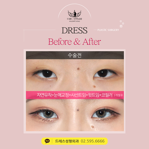 자연유착쌍꺼풀+눈매교정+사선트임+윗트임+코필러