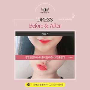 팔팔암살주사 (이중턱 윤곽주사)+입술필러