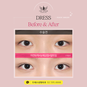 자연유착쌍꺼풀+눈매교정+앞트임