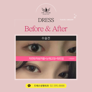 자연유착쌍꺼풀+눈매교정+윗트임