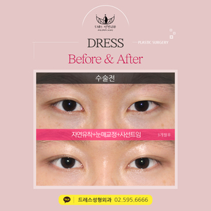 자연유착쌍꺼풀+눈매교정+사선트임