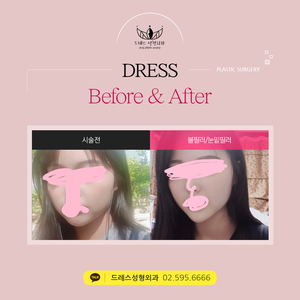 볼필러+눈밑필러