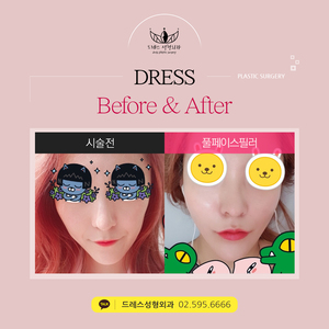 풀페이스필러